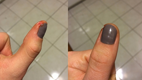 Hurt thumb cooking accident